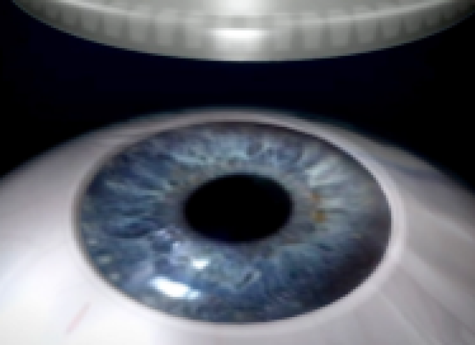 비쥬맥스라식 수술방법