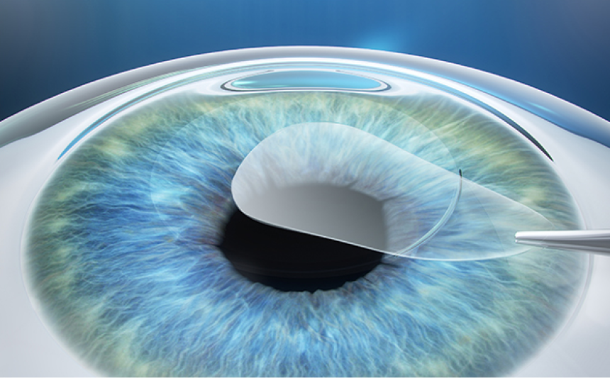 Lenticule 제거로 시력교정